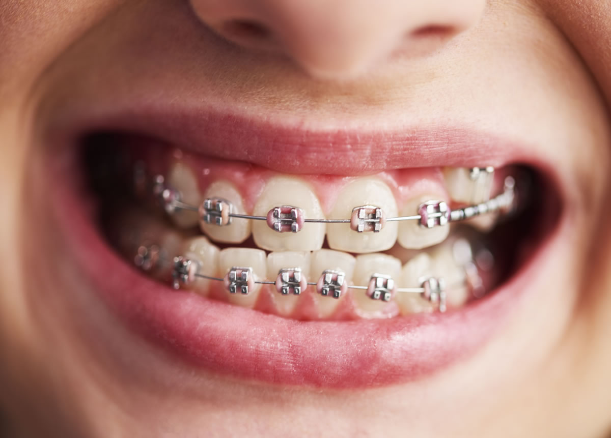 braces-kids-colm-smith-dental-cavan-monaghan-l